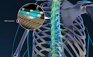 我又能走路了! 美新脊隨研究突破性進展 3癱瘓患者能夠再次行走！