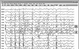 一生從眼前飛過!  科學證實真有「人生跑馬燈」 瀕死前腦電圖信號增強