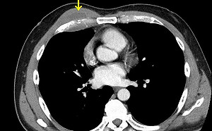 愛吃未熟雞蛋惹禍！罕見沙門氏菌感染致胸腔長膿瘍