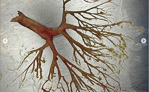 50歲男呼吸衰竭「咳出人蔘」 醫師Po出震撼照 網大驚：是被寄生嗎