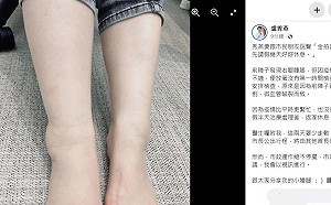 盧秀燕跌倒腳傷請假2天 向市民說「金拍謝」