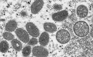 全美首例！新冠加猴痘 男子連續幾周痛苦到無法下床