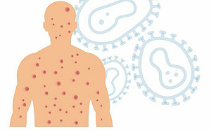 猴痘疫情爆發！美國加州進入「緊急狀態」