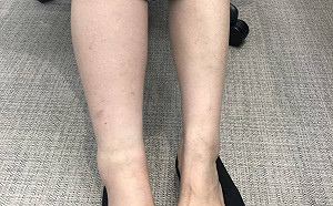 兩頭燒！連續槍擊案被叮滿頭包 盧秀燕腳傷取消行程送醫治療