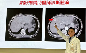 顯影劑恐讓人失智？放射線醫學會駁：該研究未紀錄個案正確使用量