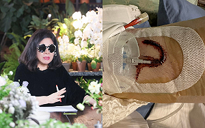 滲血打破紀錄 陳文茜曝「左手瘀血一片」