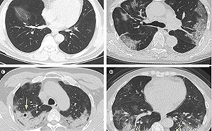這照片最近在中國到處可見! 大「白肺」驚人 醫師 : 罹患者性命堪憂