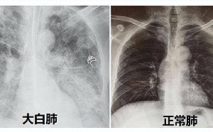 那跟什麼有關? 「大白肺現象」瘋傳 北京「闢謠」：與原毒株、疫苗接種無關