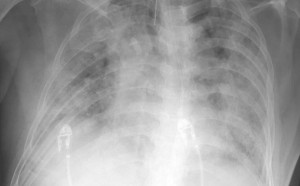 過勞確診成「大白肺」！60多歲男「葉克膜搶救20天」仍宣告不治