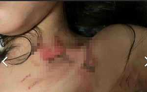 高雄幼兒在校燙傷   教育局：涉案助理員已解聘、查校方是否霸凌