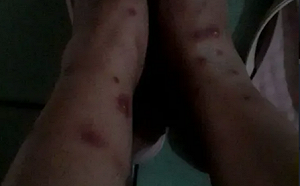 女看護僱阿嬤竟中猴痘？滿腿膿疱照曝光！羅一鈞說話了