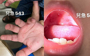 腸病毒單周萬人就診　醫列7前兆：立即住院