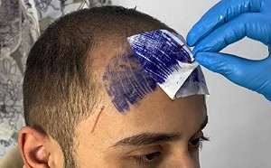 為遮禿頭「刺青瀏海」！26歲男結局超悲慘