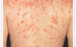 美國梅毒大爆發！5年內確診數激增74%  專科醫憂：台灣恐受影響