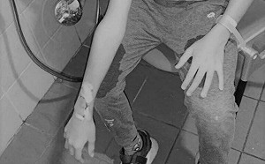 男童爆智慧手錶炸傷！業者發聲明分析：恐因使用舊版電池釀災