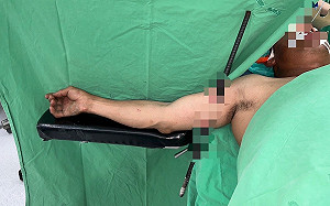 工人遭鋼筋穿臂 高市大同醫院整外妙手回春一週出院