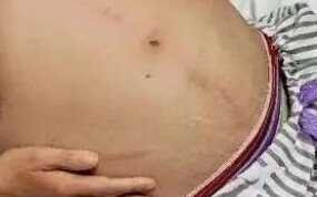 她肚子裏有「蟒蛇」? 女子患「這種病」 手術竟取出「1公尺巨蟒」