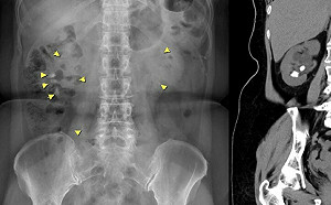 揪出反覆尿道結石「隱形殺手」！專業醫曝：與副甲狀腺亢進有關