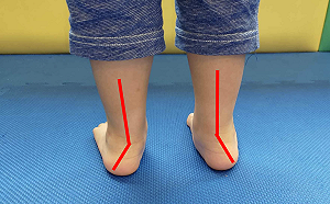 孩子常跌倒恐因「扁平足」釀禍！專科醫曝辨識2法