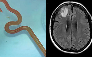 全球首例！澳洲婦人大腦取出8公分活的蛇蛔蟲