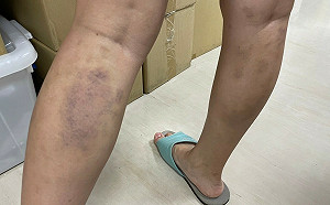 小腿肚「撥筋」後宛如家暴傷 醫提醒有些症狀恐不宜