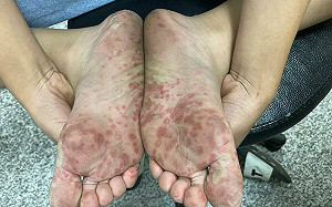 PO手、腳嚴重紅點照  醫稱腸病毒發病讓人「怵目驚心」：恐讓全身出疹！ 