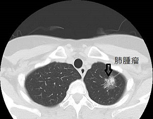 肺癌病友福音!健保擴大給付標靶藥「泰格莎」患者年省115萬