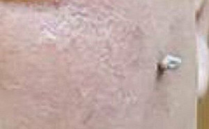 金正恩臉上多了這東西? 疑感染hpv病毒 網傳結果最糟會得癌症