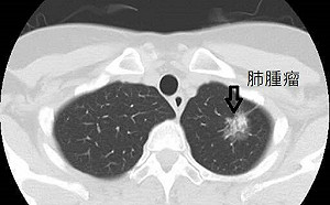肺癌病友福音！健保擴大給付標靶藥「泰格莎」患者年省115萬
