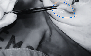 秘魯驚魂！台男遭馬蠅蟲卵寄生嘴唇 醫師開刀取出3幼蟲 