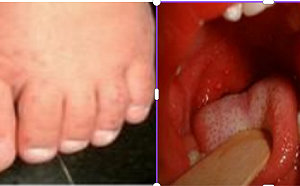 「這病毒」正大流行！部份學校已停課 兒科醫警告：酒精殺不死「他 」