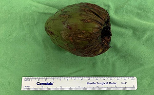 醫院斷層掃描發現台男把椰子塞肛門導致無法排尿 登英國醫學期刊!