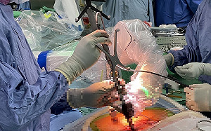 中榮領先全國引進脊椎瑪佐機械手臂 順利完成全國首例手術