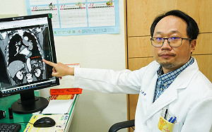 老翁三期小細胞肺癌存活率低 螺旋刀放射治療搭配化療抗癌成功