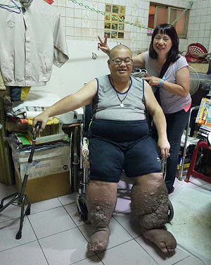 相挺渡難關！象腿人林建中亟待援助