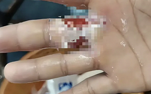 真有海公公「化骨水」? 深圳女子聲稱手遭侵蝕 醫院表示未收治此人