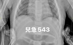 巴克球超危險！1歲童竟吞10顆釀腸穿孔 醫警告：初期無症狀難察覺