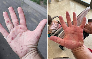 俄羅斯9地爆疫情!手上出紅疹 政府緊急採取措施 病原體竟來自這國...