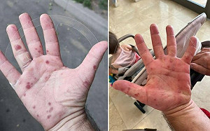 俄羅斯9地爆疫情！手上出紅疹 政府緊急採取措施 病原體竟來自這國...