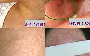 麻疹前驅症狀「3個C」 醫：若加發燒出疹要當心