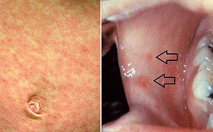 「15件事」讓你秒懂麻疹！重症醫：可1傳10、傳染力是新冠6倍