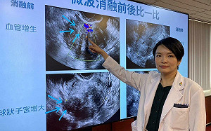 熟女受子宮腺肌症困擾5年 中榮醫以微波消融手術助她重生