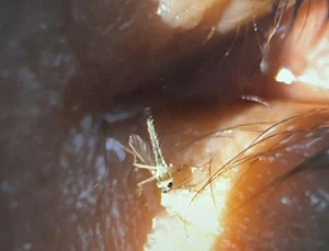 掃墓蟲入眼!高雄女眼痛3日就醫竟夾出活蚊 醫:它翅膀還在動