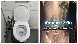 23歲女便祕17天「屎致腸破裂擠到胸腔」　醫師籲避免3惡習