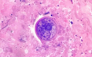 「吸一口氣就致命！」美爆神秘真菌疫情 專家警告：抗藥性強、藥物無效