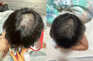 過度消毒惹禍 疫情寶寶過敏發病率增46%