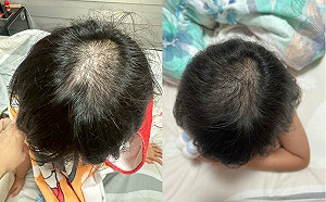 過度消毒惹禍 疫情寶寶過敏發病率增46%