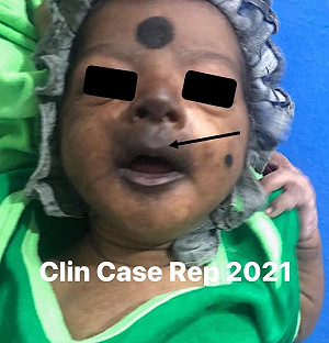 秒懂「屈公病與登革熱」差異 專家:一個痛一週、一個痛數年!