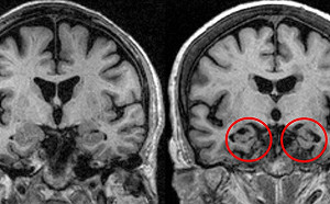 50歲男語言障礙難以表達想法 光田醫：新療法有重大進展