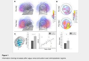 迷走神經刺激 15年植物人有恢復知覺跡象